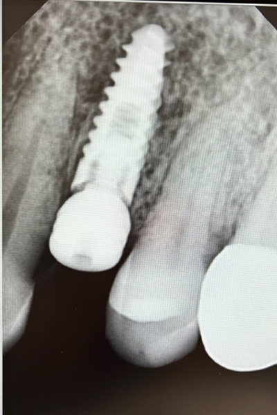 anderson-family-dentist-implant-slider-022123-2