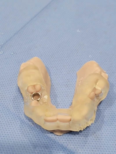 anderson-family-dentist-implant-slider (6)