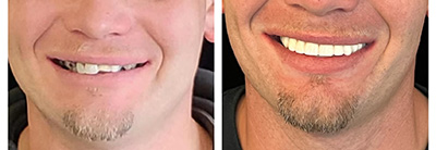 cosmetic dentistry- before and after photo full face