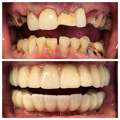 cosmetic dentistry- before and after photo of dental work close up