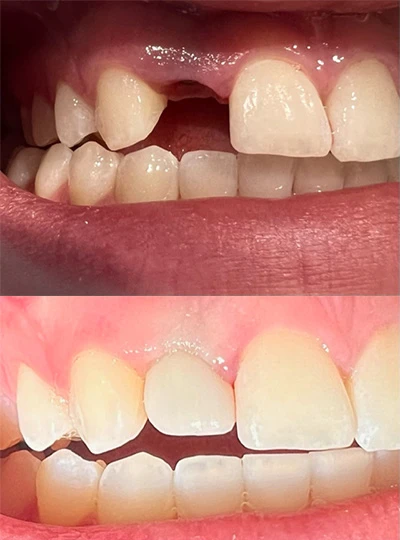 closeup showing the results of a patient's smile after getting dental implants at Anderson Family Dentist