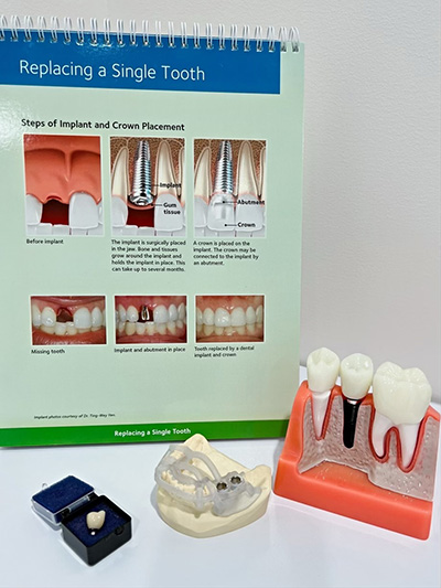 A model and diagram of how dental implants work