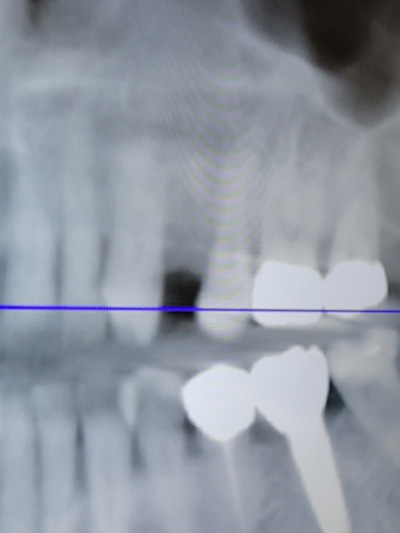 x-ray of a dental implant