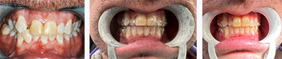 Before and After work of Invisalign patient