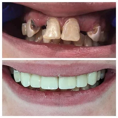 dental fillings done by Anderson Family Dentist
