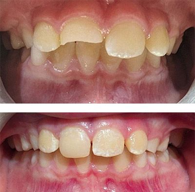 before and after emergency dentistry work 